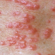 Illustration for article titled Obat kudis di apotik